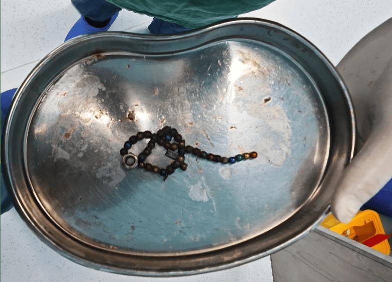 拜仁慕尼黑足球
_整整37颗拜仁慕尼黑足球
！云南4岁孩子身体里取出……医生紧急提醒！