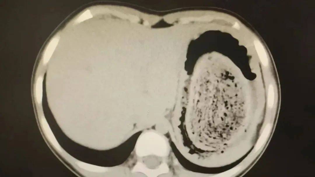 皇冠平台_发现一例皇冠平台，10岁女孩确诊！已有多起病例，有人因羞耻感延误就医