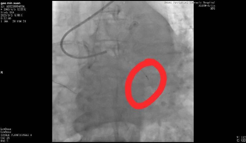 皇冠信用网_河南一老人做冠脉造影手术时一截导丝断在血管中皇冠信用网！院方回应