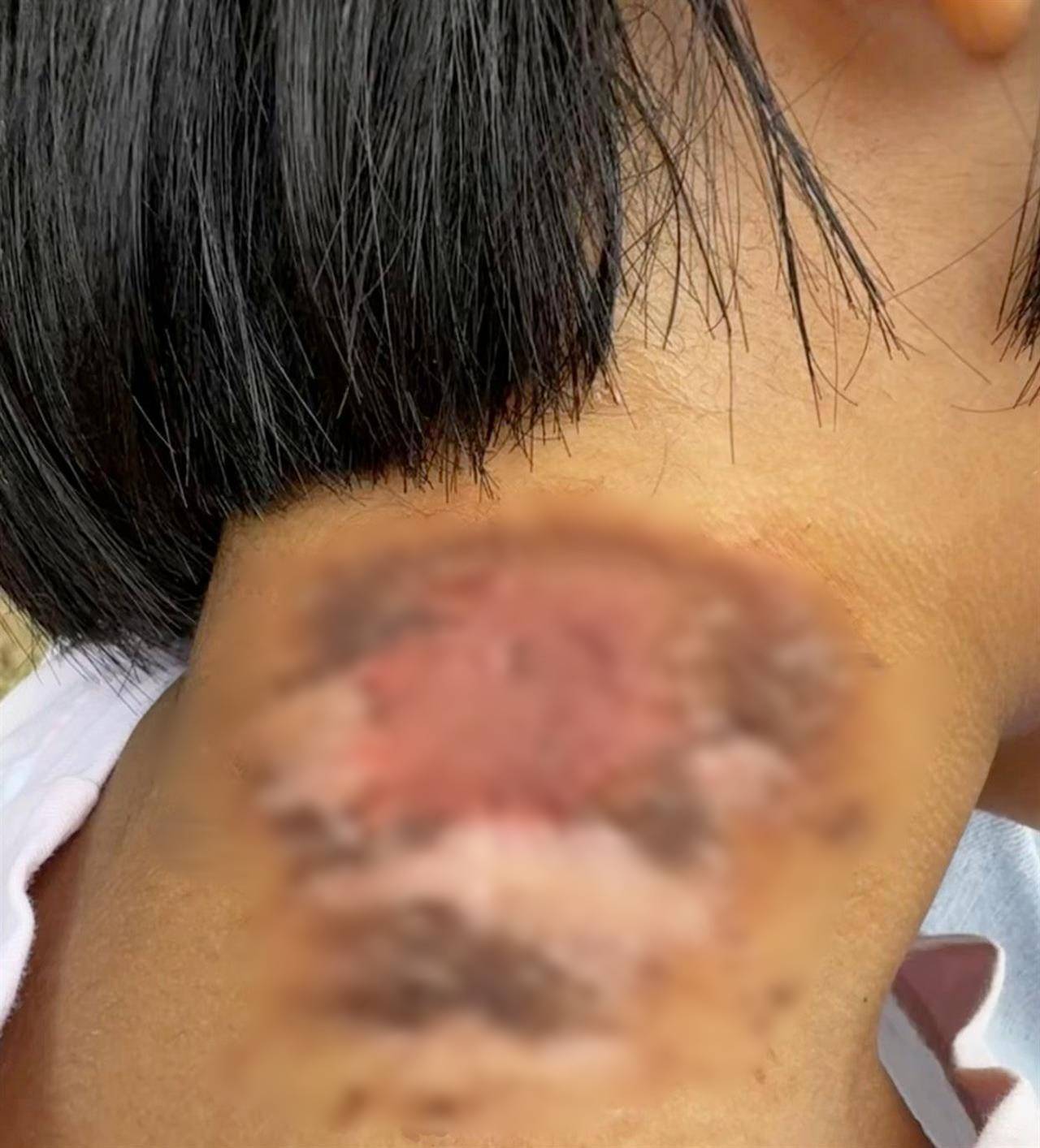 如何代理皇冠信用网_河南多地现“行走的硫酸”：洛阳一工地脚手架密密麻麻全是如何代理皇冠信用网，南阳4岁女童沾上它脖子红肿溃烂20余天未痊愈