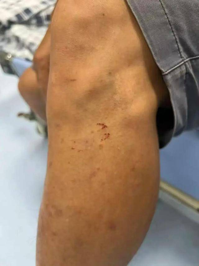 皇冠信用網需要押金吗
_广东62岁阿叔网鱼网到2条眼镜蛇皇冠信用網需要押金吗
，被咬伤后当场打死，并打包提进医院