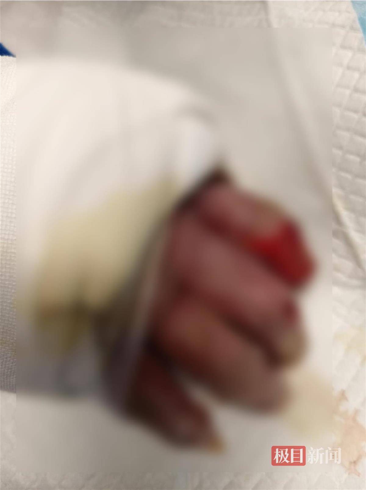 皇冠信用盘怎么开户
_男子帮邻居关液化气瓶遭遇爆炸皇冠信用盘怎么开户
,严重烧伤4个月后不幸离世,家属:治伤花了近140万,将为他申请见义勇为