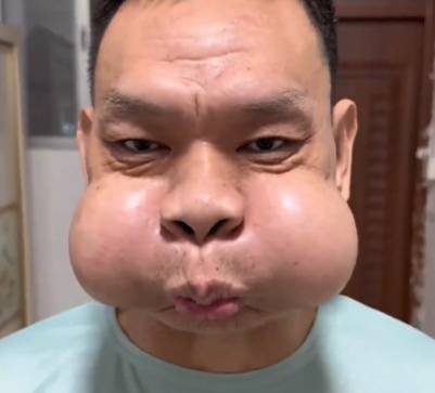 皇冠信用網代理占成_广东一男子吹玻璃30年致腮帮变形皇冠信用網代理占成，调侃自己是“青蛙王子”会蛤蟆功