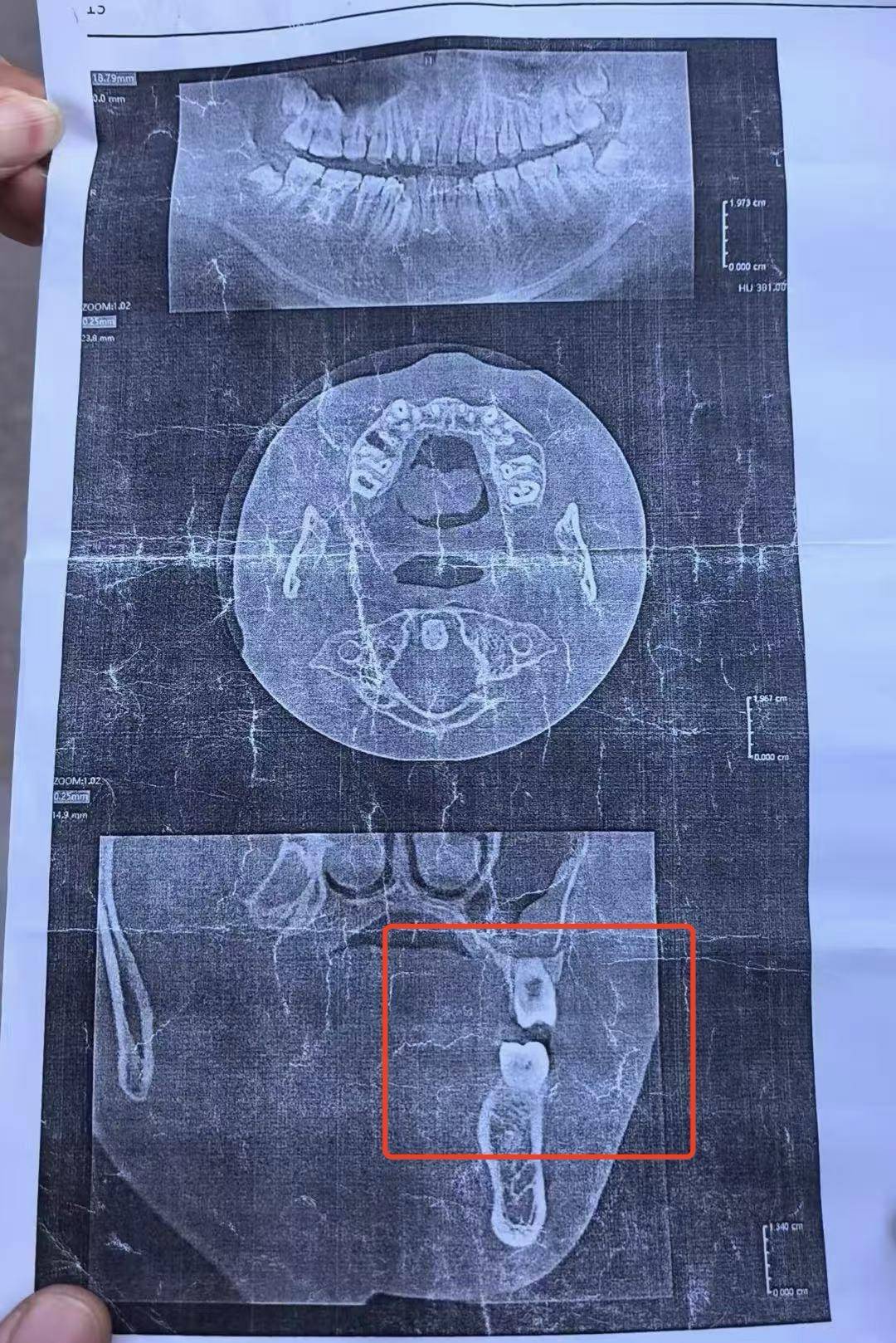 皇冠信用网如何注册_初三男生与体育老师发生冲突面部被打骨折皇冠信用网如何注册，校方：已开除涉事老师，正协商赔偿事宜